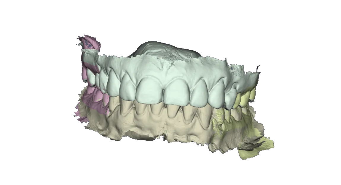 Modelo 3D dental (formato STL) de la dentadura del paciente
