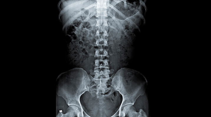 Radiografía de abdomen 2 días antes de la consulta: se observa una